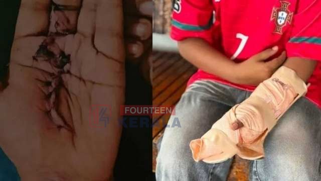 കോഴിക്കോട് കൊയിലാണ്ടി താലൂക്ക് ആശുപത്രിയിൽ ചികിത്സാപ്പിഴവെന്ന് പരാതി; ഒമ്പതാം ക്ലാസുകാരന്റെ വിരലിന്റെ ചലനശേഷി നഷ്ടമായി 1