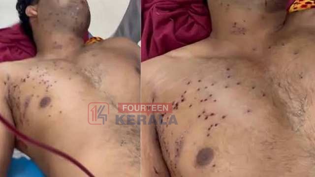 നീറ്റ് സമരക്കാർക്ക് നേരെ പെല്ലെറ്റ് പ്രയോഗിച്ചില്ലെന്ന വാദം പൊളിഞ്ഞു; യുവാവിന്റെ കണ്ണിൽ നിന്നും പെല്ലെറ്റുകൾ നീക്കം ചെയ്തു 1